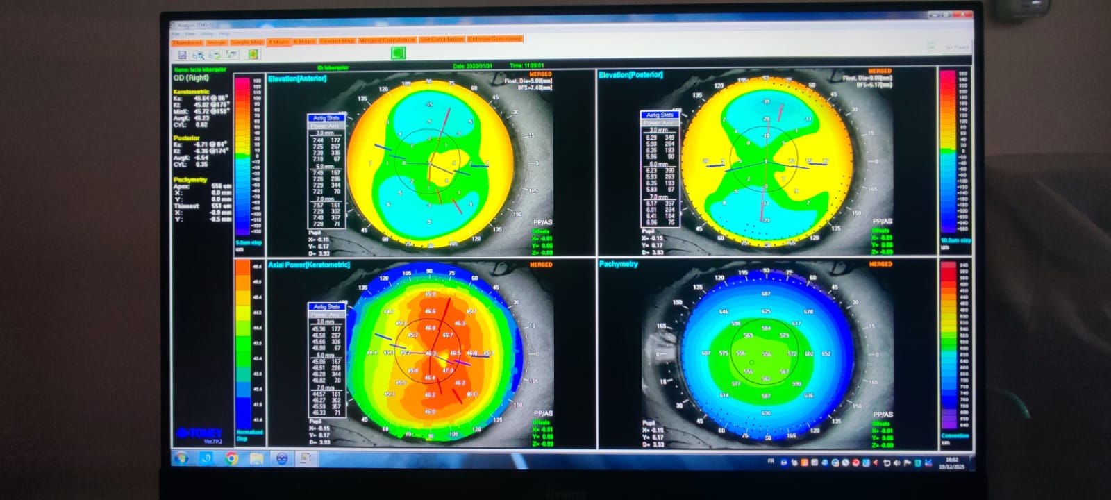 Topographie cornéenne